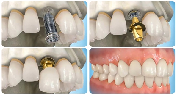 Trồng răng Implant mất bao lâu