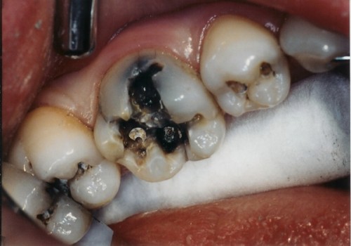 Viêm tủy răng có phục hồi lại không