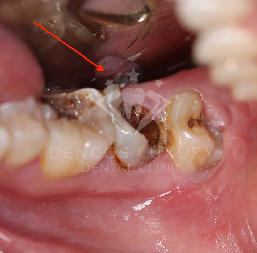 Dấu hiệu, nguyên nhân, cách điều trị viêm tủy răng 2