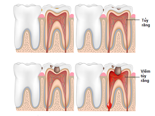 Điều trị viêm tủy răng có đau không