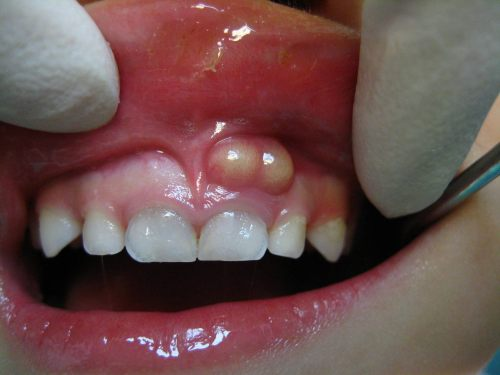 Nguyên nhân gây viêm tủy răng 4