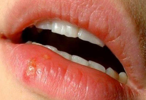 triệu chứng bệnh lở miệng
