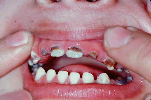 viêm tủy răng ở trẻ em