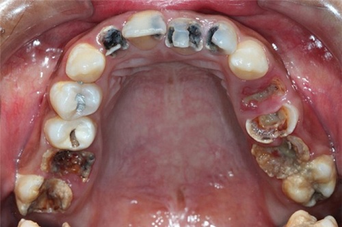 Nguyên nhân sâu răng