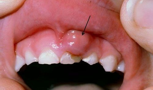 Bệnh nướu răng 2