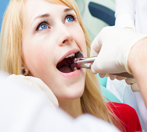 quy trình nhổ răng sâu 4