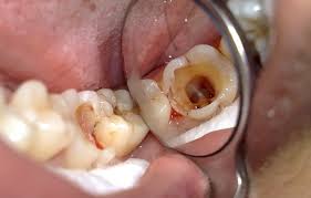 Bệnh Sâu răng
