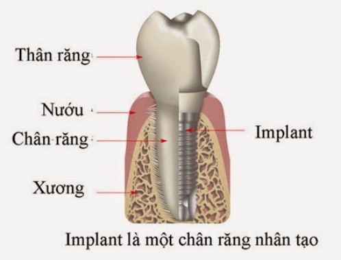 Căm răng implant 