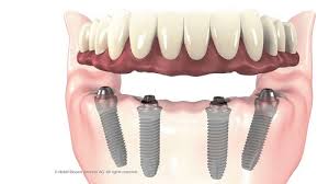 cấy răng implant
