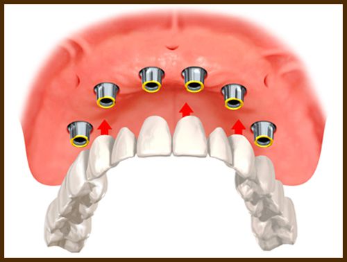 cấy ghép răng implant 