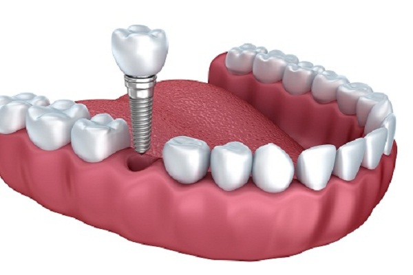 Cấy răng Implant