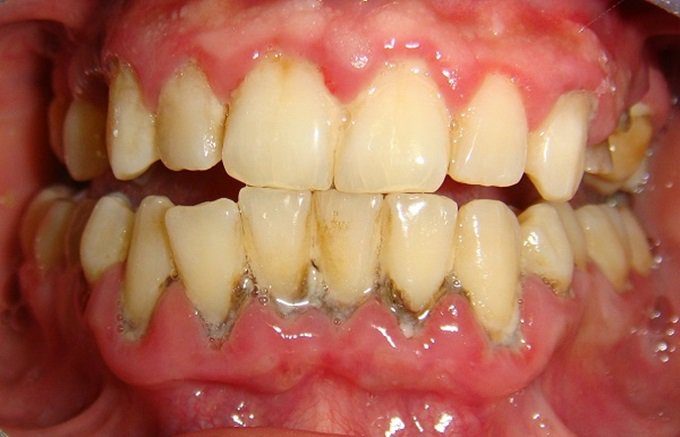 Khái niệm về cao răng