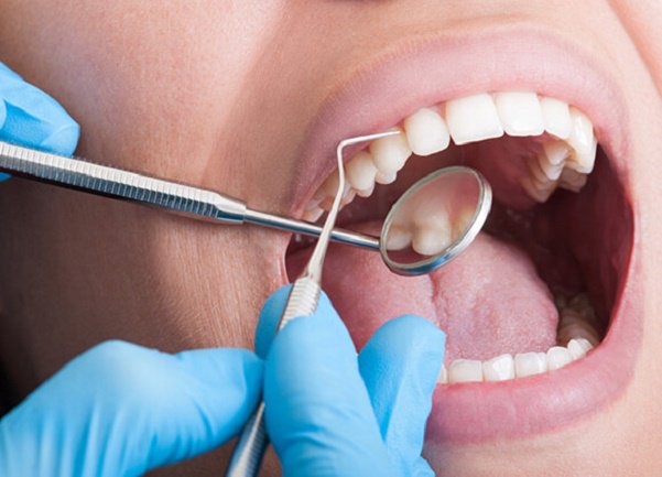 Lấy cao răng có gây đau?