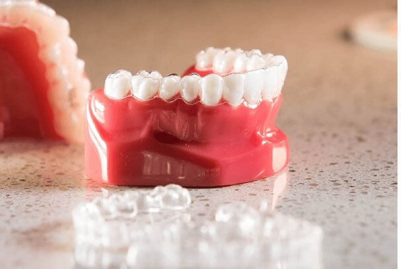 Niềng răng không mắc cài trong bao lâu?