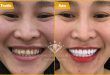 Bọc răng sứ công nghệ cao – Khắc phục toàn diện răng xấu hỏng