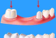 Thông tin A-Z về cầu răng sứ