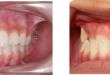 3 cách chữa sâu răng hiệu quả tại nhà