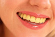 Răng bị ố vàng nguyên nhân & những điều cần biết