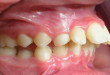 3 nguyên nhân gây răng vẩu và hướng khắc phục
