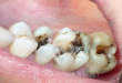Lời khuyên từ chuyên gia: “Khi nào thì nên hàn răng?”