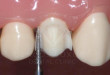 Nắn chỉnh răng vẩu như thế nào để an toàn và hiệu quả?