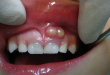 Viêm tủy răng có mủ có nguy hiểm không?
