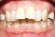 Răng hô là gì? Cách nhận biết và khắc phục như thế nào?