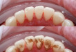 Cao răng hình thành từ đâu <<< Phân tích từ chuyên gia