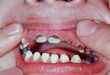 Viêm tủy răng ở trẻ em nghiêm trọng thế nào?