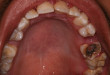 Cùng tìm hiểu: Sâu răng là gì? Chữa sâu răng như thế nào
