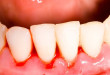Bị chảy máu nướu răng là bệnh gì?