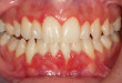 Cách chữa bệnh viêm nướu răng an toàn hiệu quả nhất hiện nay