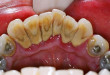 Lấy cao răng có đau không và ảnh hưởng gì đến răng? ></noscript>> BS tư vấn