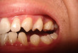 Niềng răng có khắc phục được răng thưa không? – BS nha khoa
