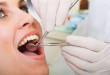 Lấy cao răng như thế nào? – Công nghệ lấy cao răng