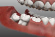 Mọc răng khôn đau bao lâu? – Tư vấn từ chuyên gia răng hàm mặt