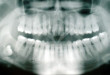 Cùng tìm hiểu: Sâu răng khôn phải làm sao?