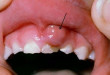 Những sự thật bạn cần biết về bệnh nướu răng