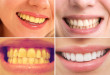 Bật mí răng bị vàng làm sao cho trắng sáng?