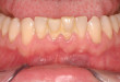 Mảng bám răng và cách phòng mảng bám trên răng