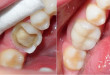 Trám răng sâu những điều bạn cần biết về trám răng