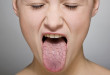 Bệnh khô miệng và cách điều trị khô miệng tận gốc