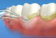 Lấy cao răng có hại gì không? – Bạn sẽ biết ngay sau khi đọc bài này