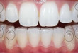 Niềng răng tháo lắp có hiệu quả không? – Kiến thức nha khoa