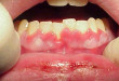 Nguyên nhân và cách trị bệnh viêm nướu răng