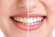 Những yếu tố quyết định có nên tẩy trắng răng không?