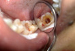 Có nên nhổ răng hàm bị sâu không?