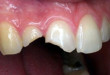 Trám răng có đau không? Trường hợp nào nên trám răng?