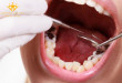 Chăm sóc răng bị sâu – Phương pháp điều trị răng sâu triệt để