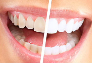 Cách làm trắng răng nhanh nhất hiệu quả ngoài mong đợi